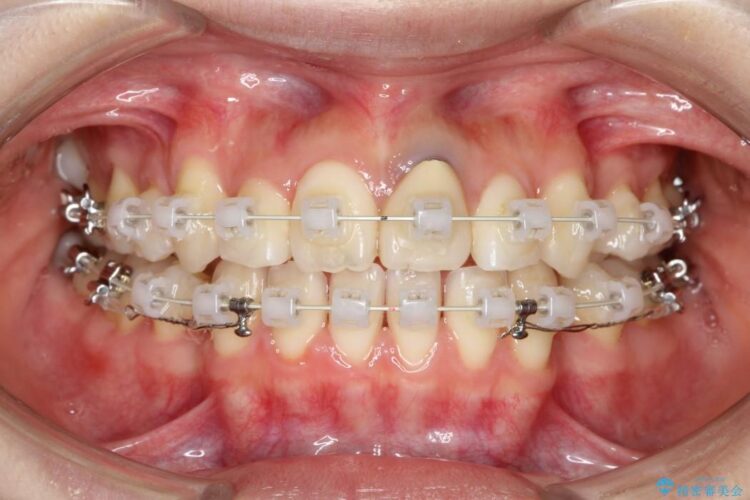 20代女性のワイヤー装置による八重歯の矯正治療 治療途中画像
