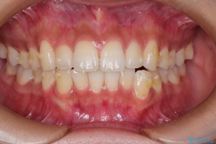 インビザラインで前歯の並びを改善 治療途中画像