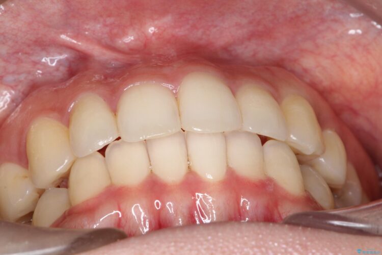 前歯のがたがた気になる　目立たないインビザラインによる矯正治療 治療後画像