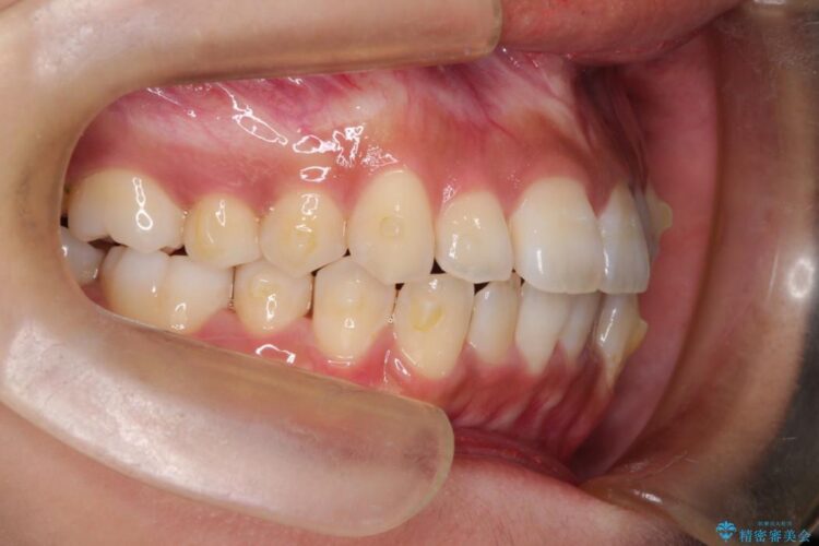 インビザラインで前歯の並びを改善 治療途中画像