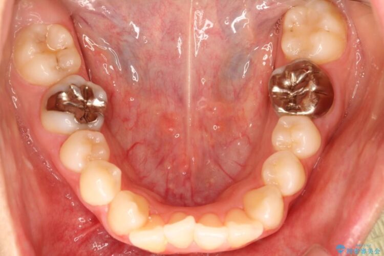 出っ歯を治したい　インビザラインによる目立たない矯正 治療前画像