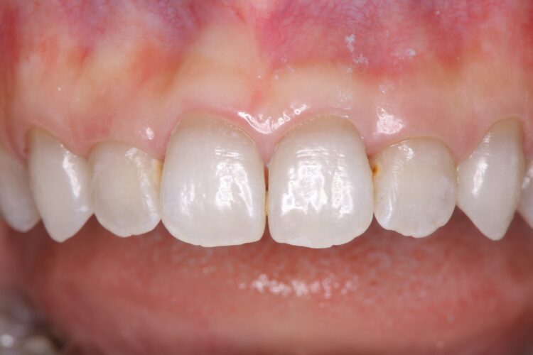 PMTCでツルツルの歯へ 治療後画像