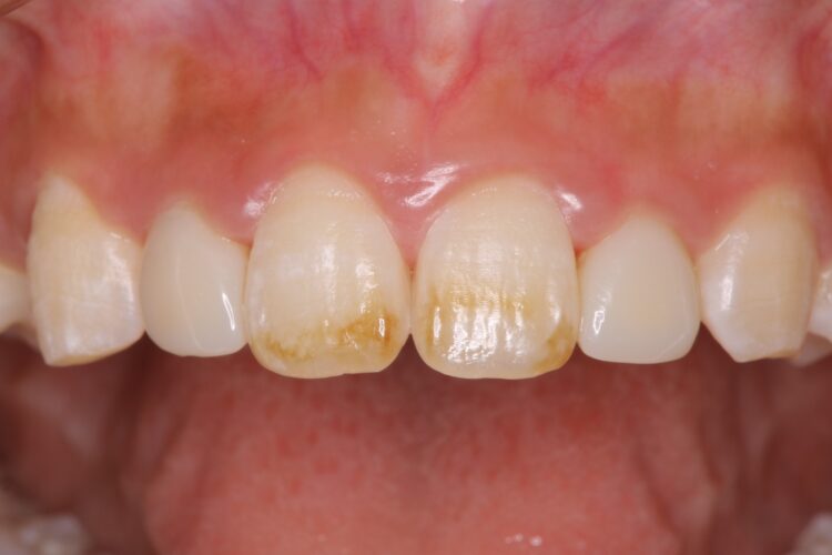 前歯の治療前にホワイトニング 治療前画像