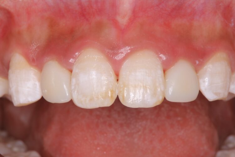 前歯の治療前にホワイトニング 治療後画像