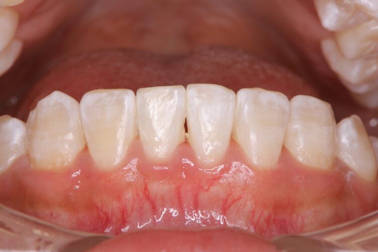 前歯の治療前にホワイトニング 治療後画像