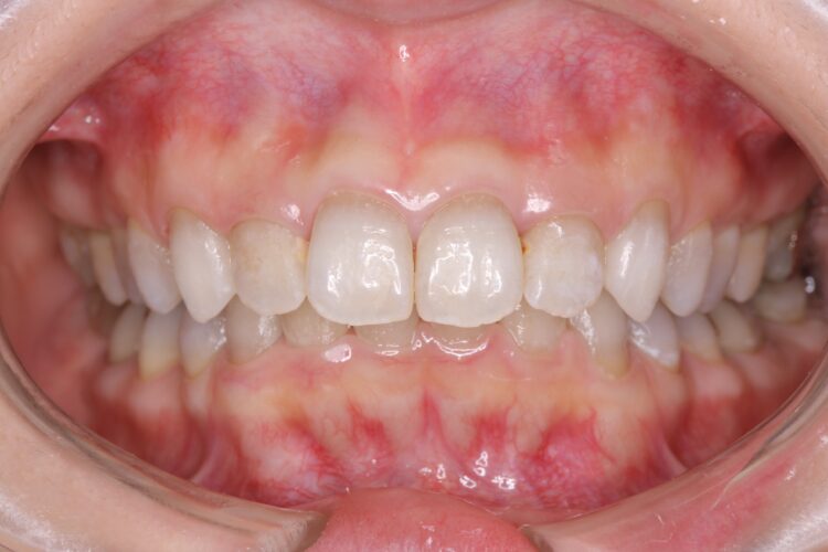 PMTCでツルツルの歯へ 治療前画像