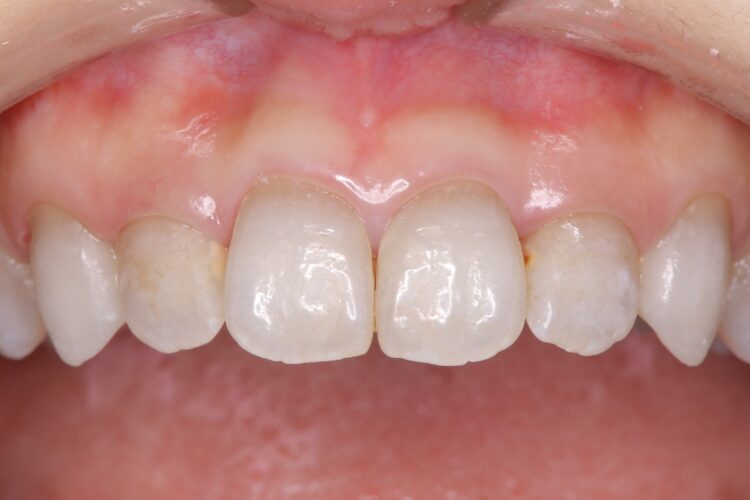 PMTCでツルツルの歯へ 治療前画像