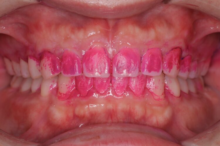 PMTCでツルツルの歯へ 治療途中画像