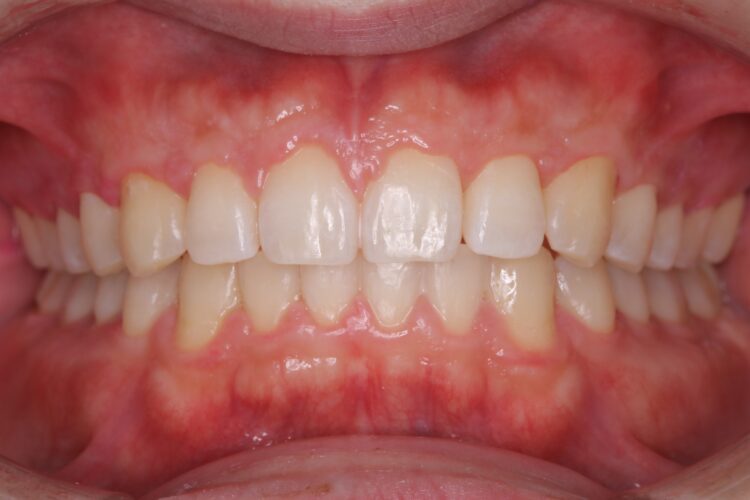 PMTCでツルツルの歯へ 治療後画像