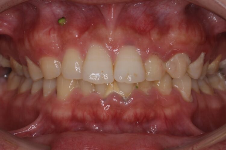 歯列矯正前の歯周病治療 治療前画像