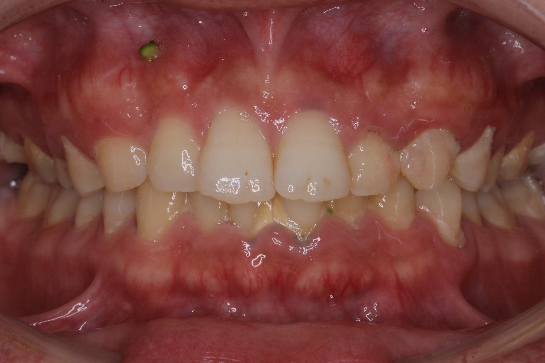 歯列矯正前の歯周病治療 治療前