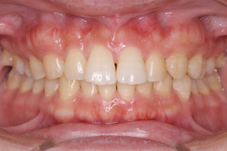 歯列矯正前の歯周病治療 治療後画像