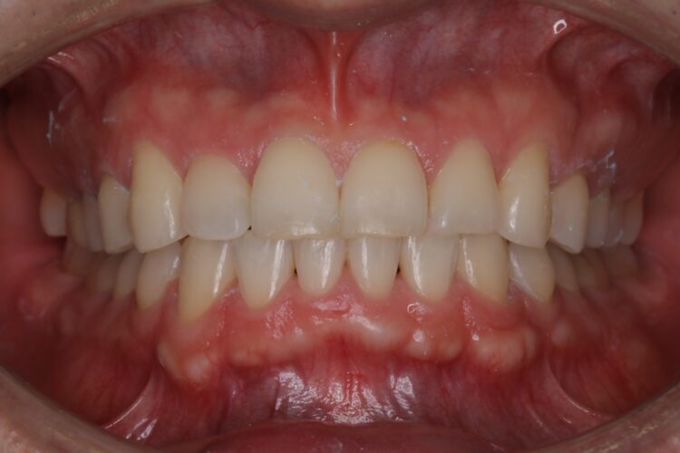矯正終了後に歯を白く 治療前画像