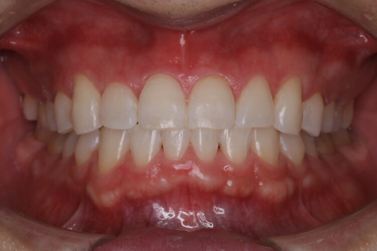 矯正終了後に歯を白く 治療後画像