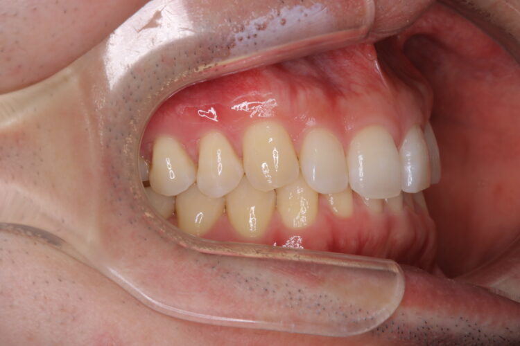 すきっ歯をインビザラインで改善 治療前画像
