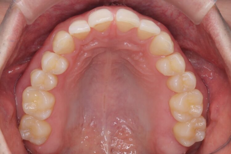 すきっ歯をインビザラインで改善 治療前画像