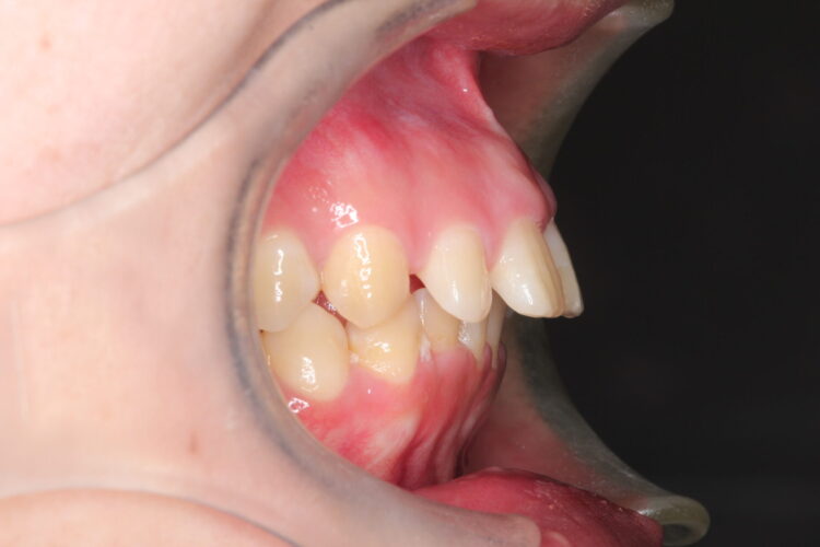 すきっ歯をマウスピースで治療 治療前画像