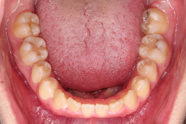すきっ歯をマウスピースで治療 治療前画像
