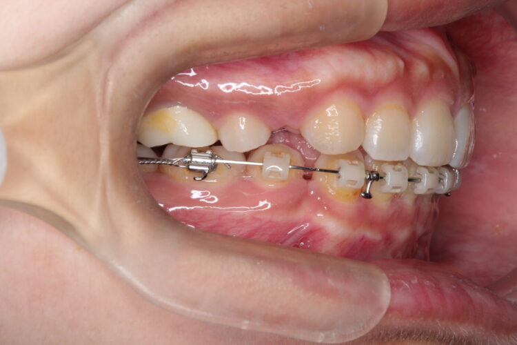 抜歯矯正で口元のコンプレックスを改善 治療途中画像