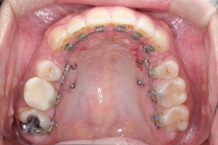 抜歯矯正で口元のコンプレックスを改善 治療途中画像