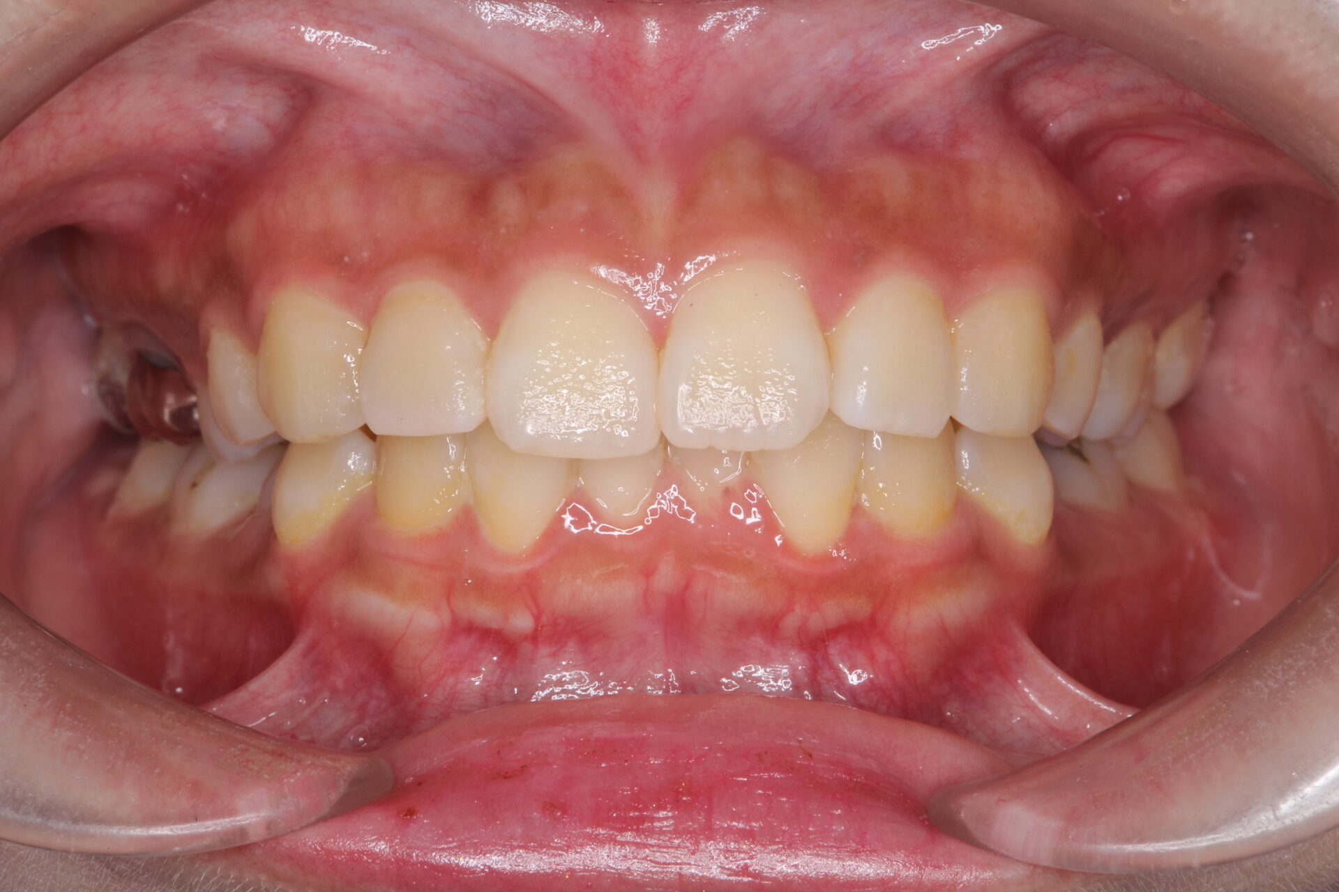 抜歯矯正で口元のコンプレックスを改善 治療前