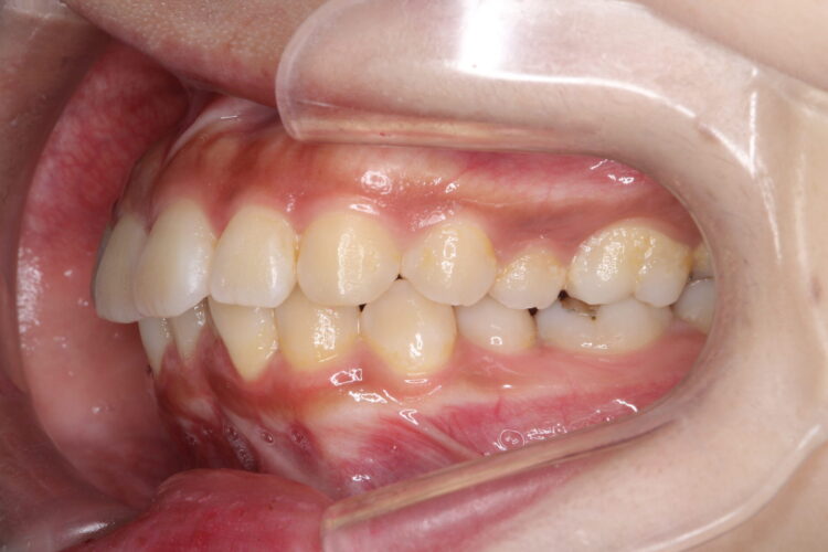 抜歯矯正で口元のコンプレックスを改善 治療前画像