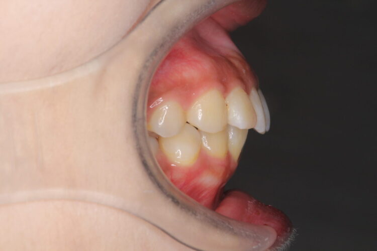 抜歯矯正で口元のコンプレックスを改善 治療前画像