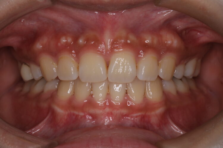 抜歯矯正で口元のコンプレックスを改善 治療後画像