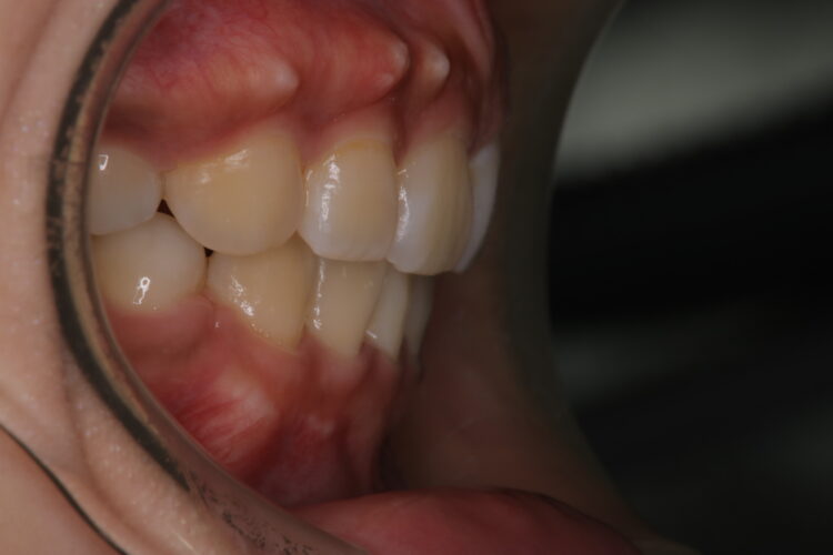 抜歯矯正で口元のコンプレックスを改善 治療後画像