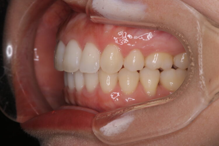 治療途中になっていた歯の再矯正 治療後画像
