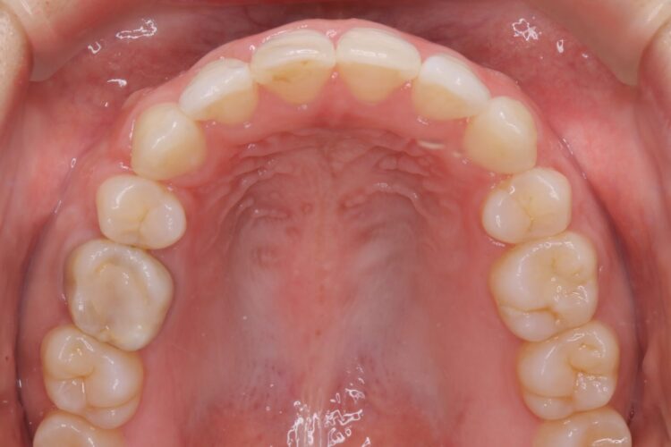 治療途中になっていた歯の再矯正 治療後画像