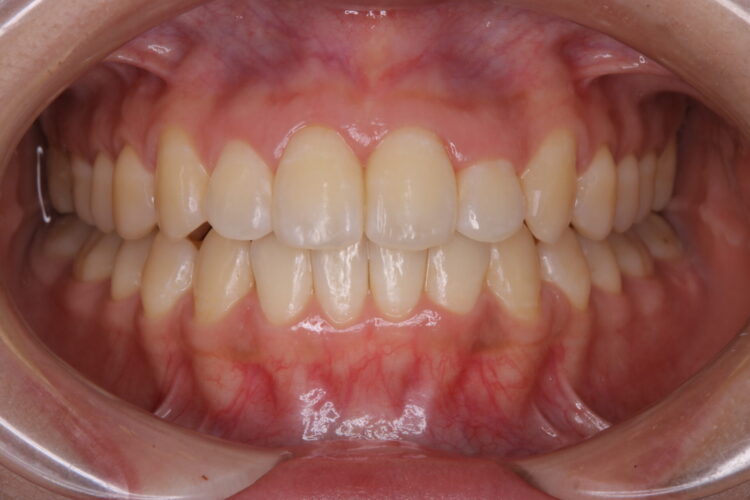 前歯のがたつきをワイヤーで短期治療 治療後画像