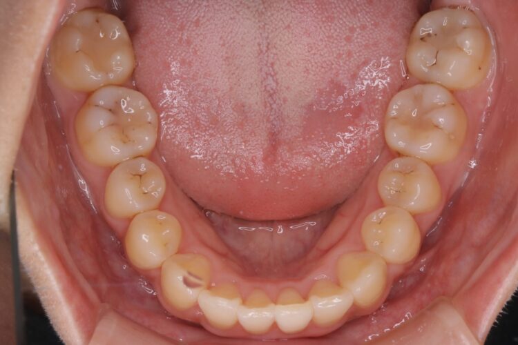 前歯のがたつきをワイヤーで短期治療 治療後画像