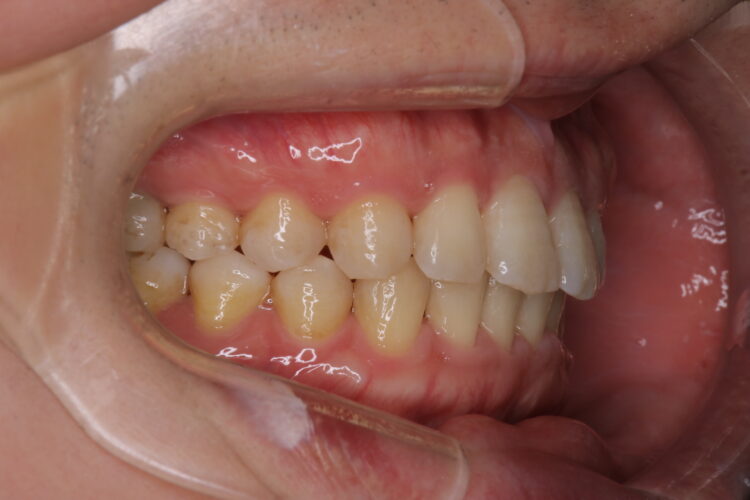 ワイヤーで短期間で歯並びをきれいに 治療後画像