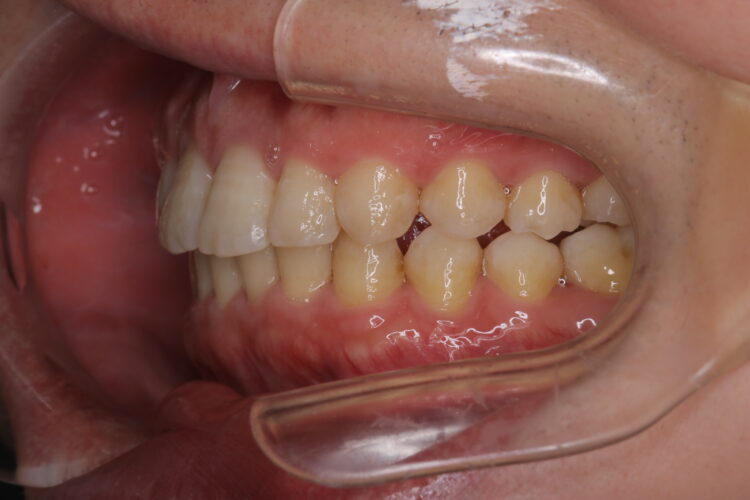 ワイヤーで短期間で歯並びをきれいに 治療後画像