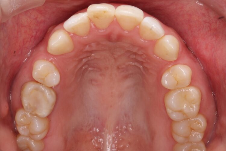 治療途中になっていた歯の再矯正 治療前画像