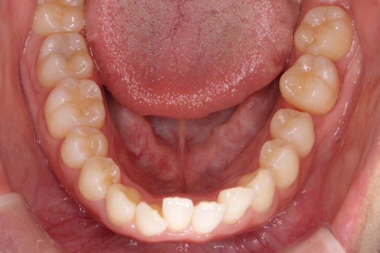 治療途中になっていた歯の再矯正 治療前画像