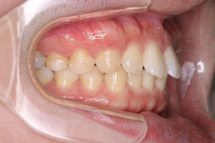 ワイヤーで短期間で歯並びをきれいに 治療前画像
