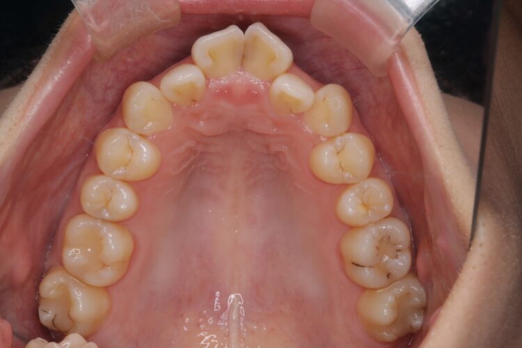 前歯のがたつきをワイヤーで短期治療 治療前画像
