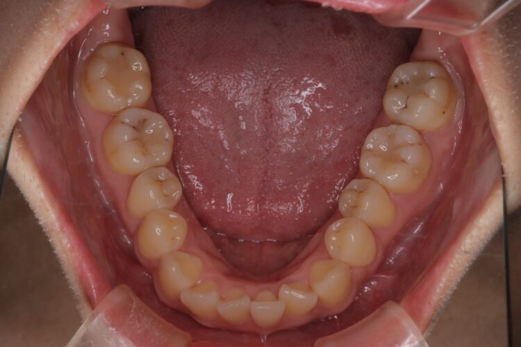 前歯のがたつきをワイヤーで短期治療 治療前画像