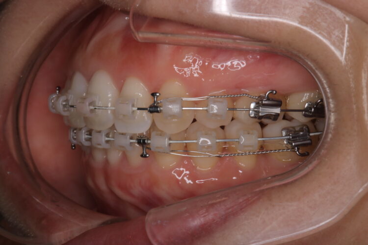 治療途中になっていた歯の再矯正 治療途中画像