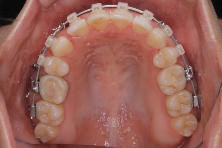 治療途中になっていた歯の再矯正 治療途中画像