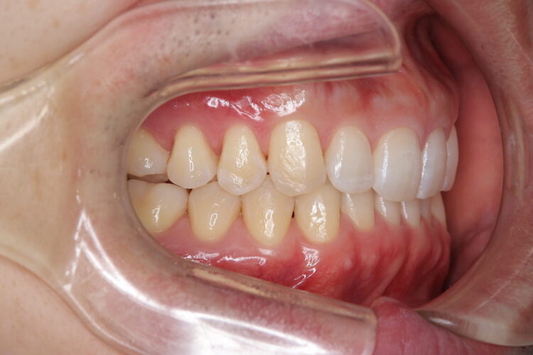 すきっ歯をインビザラインで改善 治療後画像