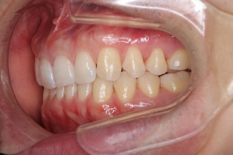 すきっ歯をインビザラインで改善 治療後画像