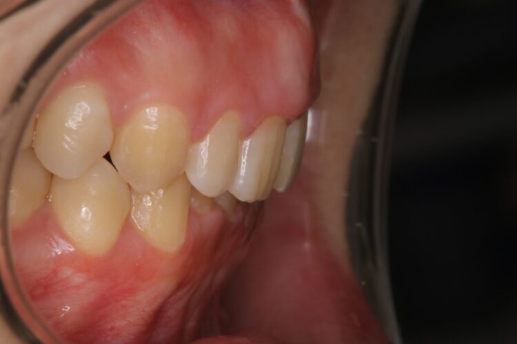 すきっ歯をマウスピースで治療 治療後画像