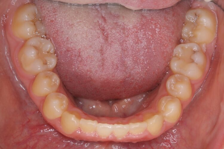 すきっ歯をマウスピースで治療 治療後画像