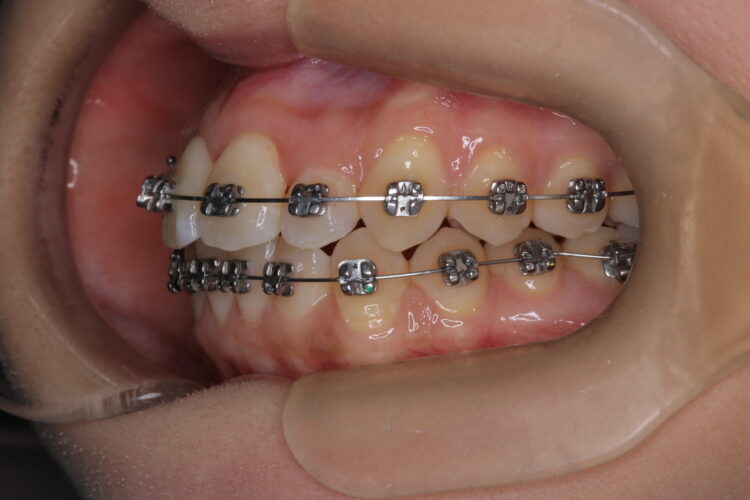 前歯のがたつきをワイヤーで短期治療 治療途中画像