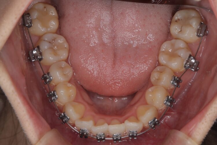 前歯のがたつきをワイヤーで短期治療 治療途中画像