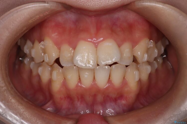 インビザラインでオープンバイトの改善 治療途中画像