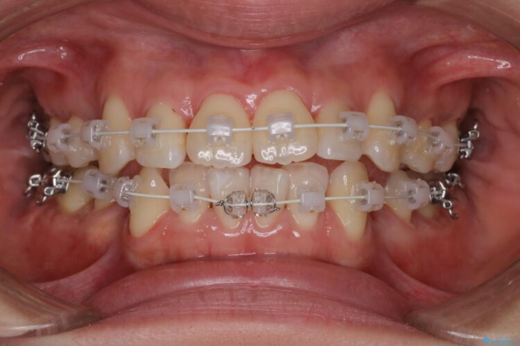 審美装置で前歯のデコボコを改善 治療途中画像